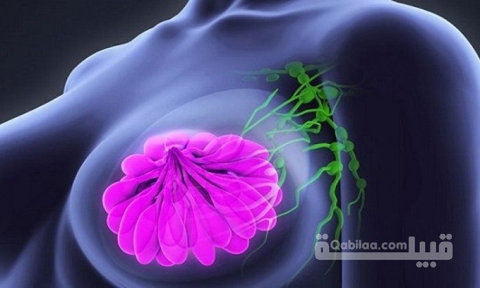 هل يعود سرطان الثدي بعد العلاج الإشعاعي