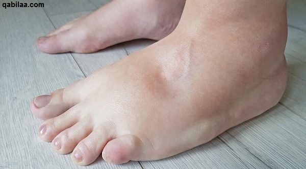 اسباب تورم القدمين عند النساء